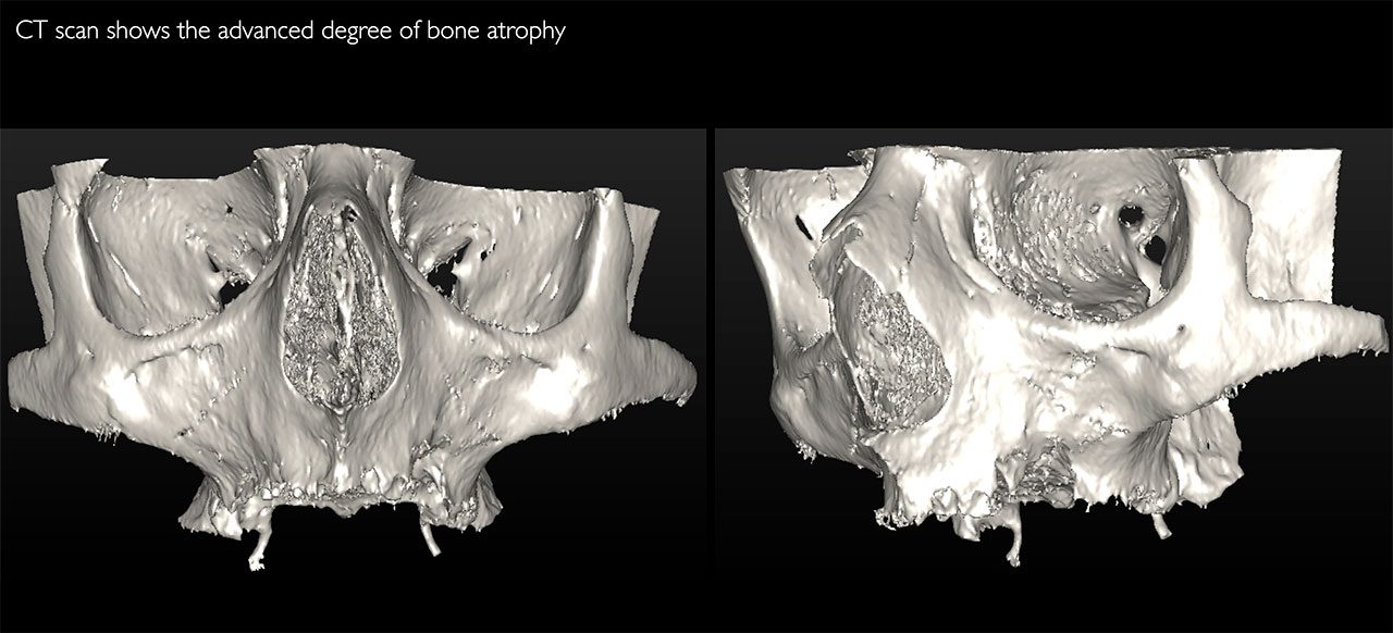 Atrofia-ossea-avanzata