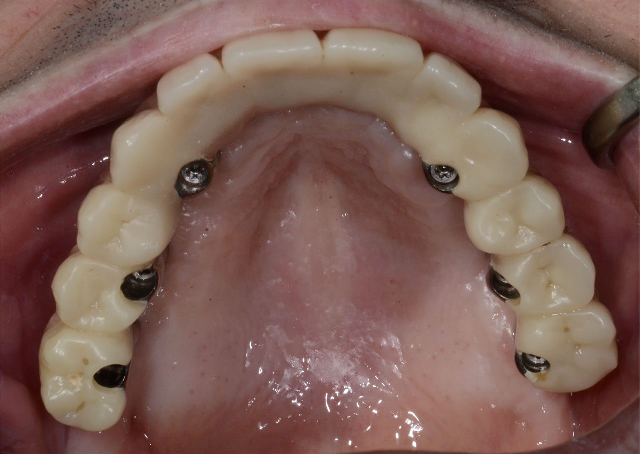Atrofie estrema del mascellare superiore, impianto AMSJI