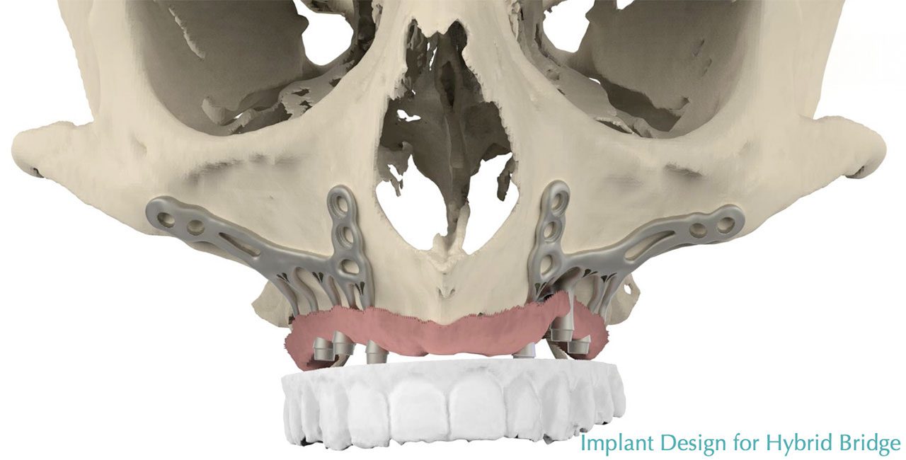 Implant Disign from Hybrid Bridge