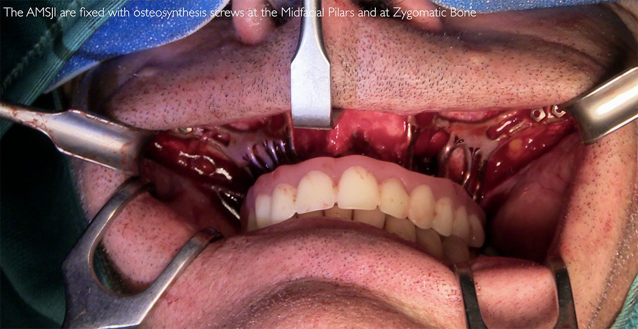 Impianti AMSJI fissati con viti da osteosintesi e protesi temporanea