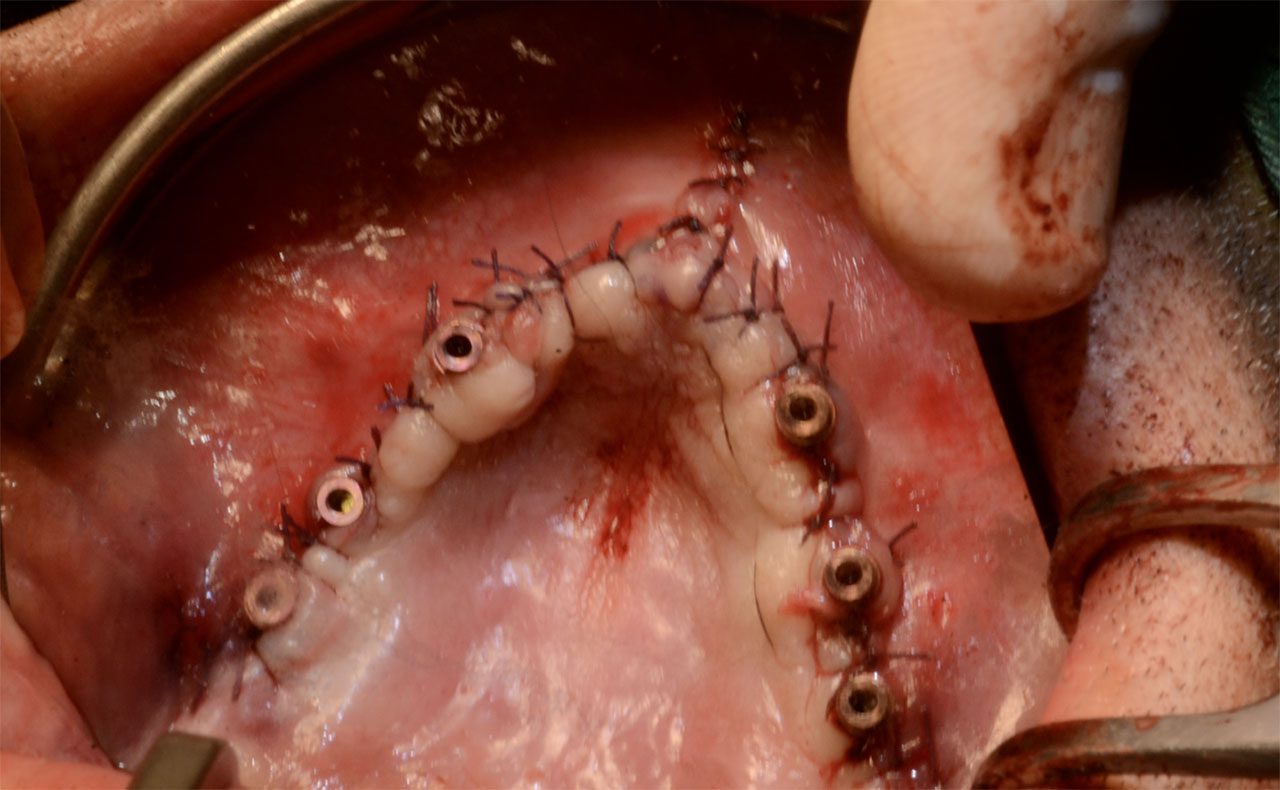 Impianti AMSJI sutura