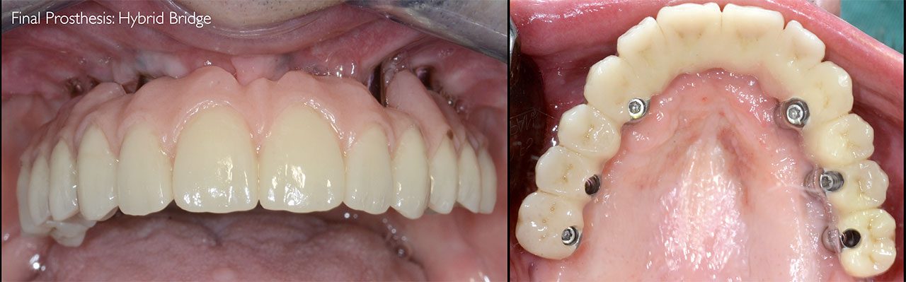 Atrofie estrema del mascellare superiore, impianto AMSJI Struttura protesica fissa