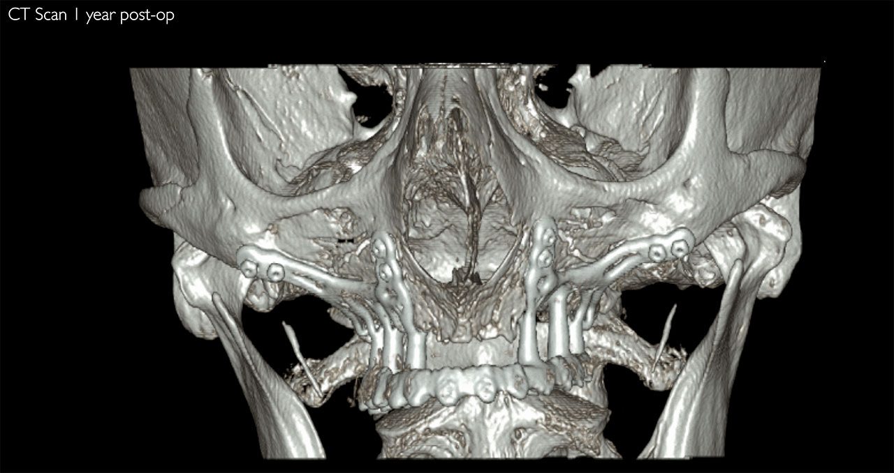 Atrofie estrema del mascellare superiore, impianto AMSJI