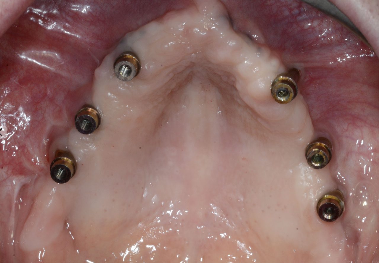 A tre anni, visione delle connessioni protesiche